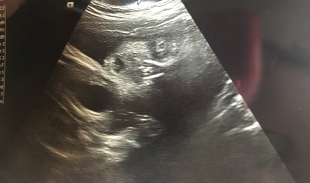 エコー写真 28週5日 28w5d 男の子,妊娠28週,エコー,