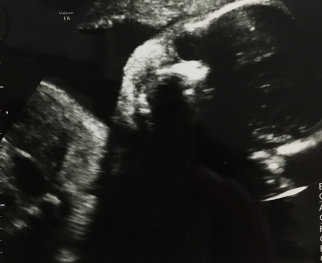 エコー写真 29週4日 29w4d 女の子,妊娠29週,エコー,