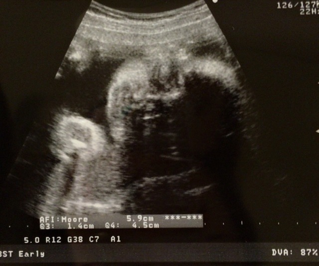 エコー写真 30週5日 30w5d 男の子,妊娠,30週,エコー写真