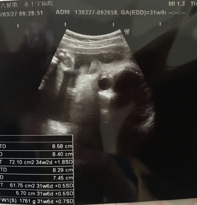 エコー写真 31週0日 31w0d 男の子,妊娠,31週,エコー写真
