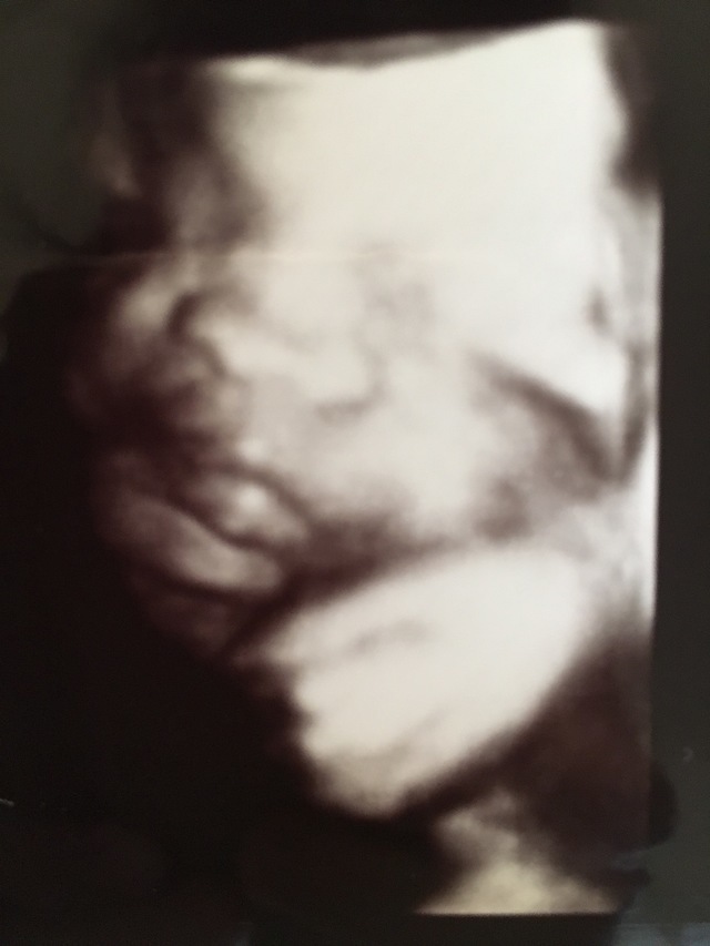 エコー写真 31週1日 31w1d 女の子,妊娠,31週,エコー写真