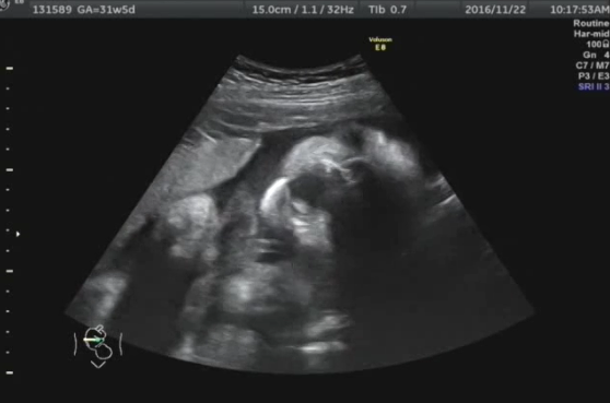 エコー写真 31週5日 31w5d 女の子,妊娠,31週,エコー写真