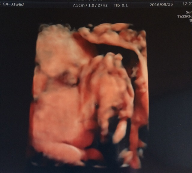 エコー写真 31週6日 31w6d 女の子,妊娠,31週,エコー写真