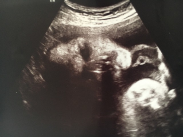 エコー写真 31週6日 31w6d 男の子,妊娠,31週,エコー写真