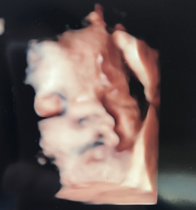 37週0日 37w0d 男の子,妊娠37週,エコー,