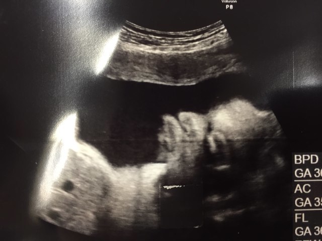 37週1日 37w1d 女の子,妊娠37週,エコー,