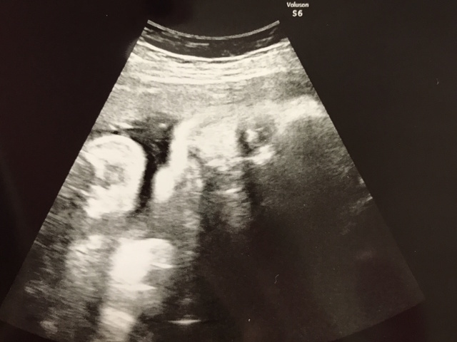 37週3日 37w3d 男の子,妊娠37週,エコー,