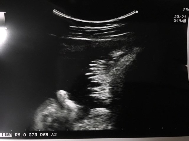 37週3日 37w3d 男の子,妊娠37週,エコー,