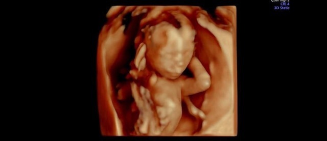 エコー写真 16週4日 16w4d 男の子,妊娠16週,エコー写真,