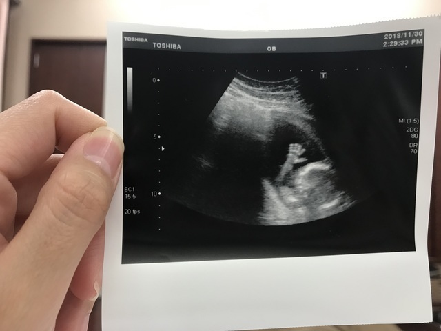 エコー写真 16週5日 16w5d 女の子,妊娠16週,エコー写真,
