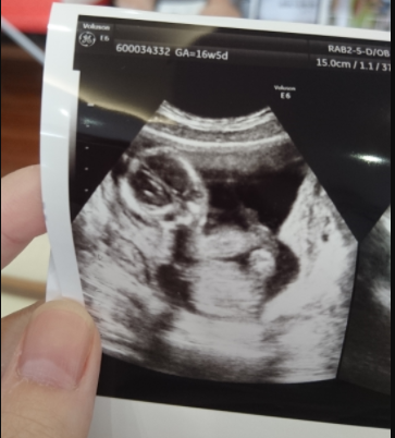 エコー写真 16週5日 16w5d 女の子,妊娠16週,エコー写真,