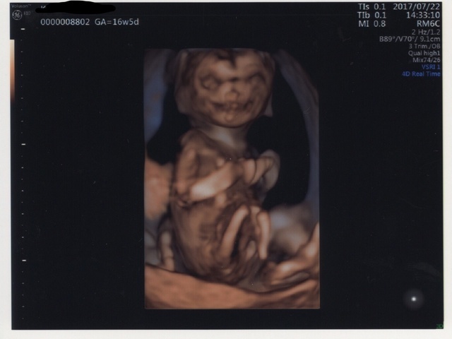 エコー写真 16週5日 16w5d 男の子,妊娠16週,エコー写真,