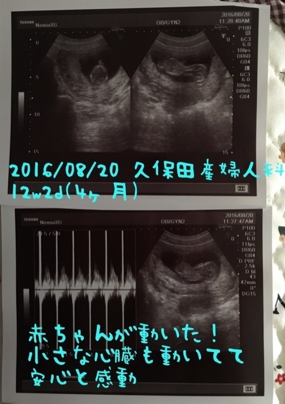 エコー写真 12週2日 12w2d 女の子,妊娠,12週,エコー写真