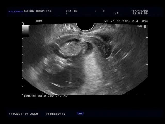 エコ―写真 12週2日 12w2d 男の子,妊娠,12週,エコー写真
