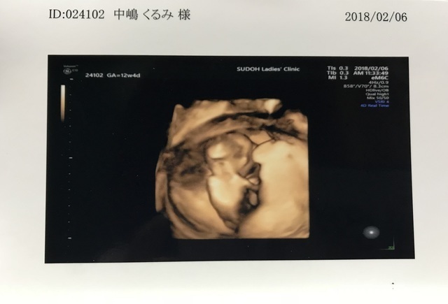 エコ―写真 12週4日 12w4d 男の子,妊娠,12週,エコー写真