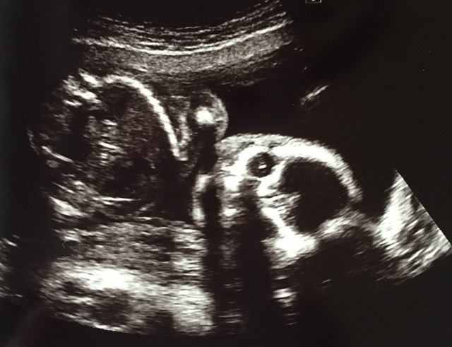 エコー写真 21週0日 21w0d /男の子,妊娠21週,エコー,