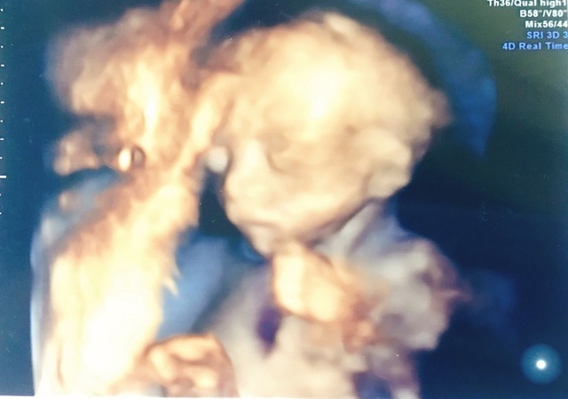 エコー写真 21週3日 21w3d 女の子,妊娠21週,エコー,