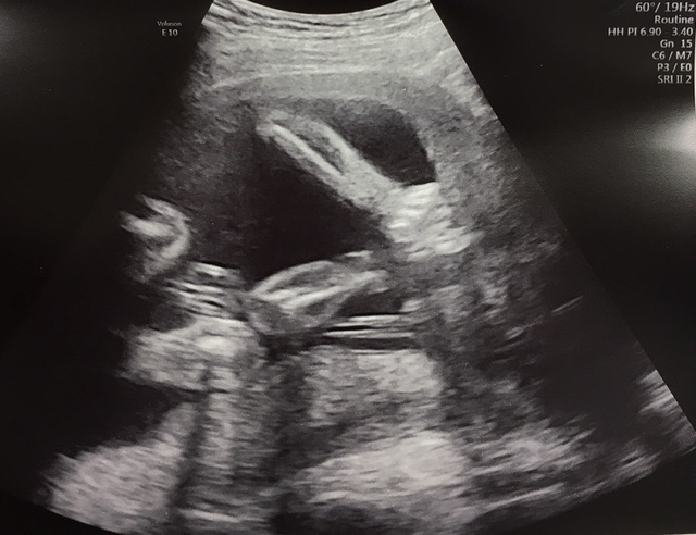 エコー写真 21週5日 21w5d 男の子,妊娠21週,エコー,