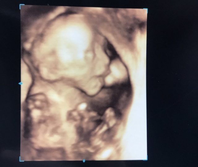エコー写真 21週5日 21w5d 女の子,妊娠21週,エコー,