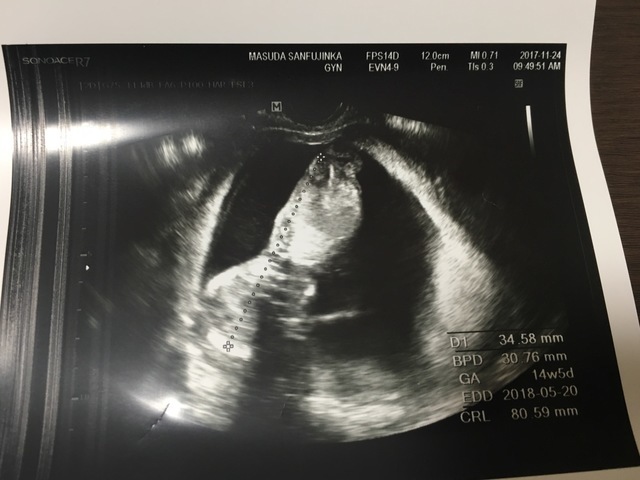 エコー写真 14週5日 14w5d 男の子,妊娠14週,エコー写真,
