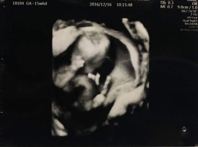 エコー写真 15週6日 15w6d 男の子 ,妊娠,15週,エコー写真