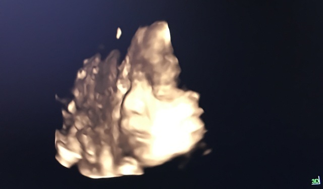 エコー写真 26週5日 26w5d 男の子,妊娠26週,エコー,