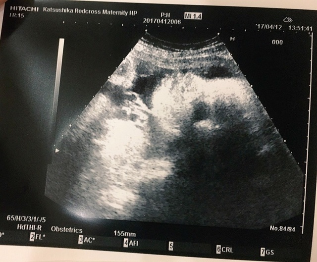 エコー写真 17週 17w 男の子,妊娠17週,エコー,