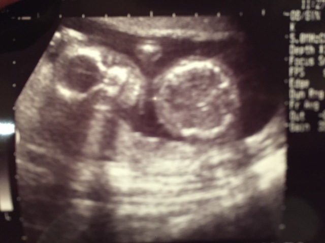 エコー写真 20週1日 20w1d 男の子,妊娠20週,エコー,
