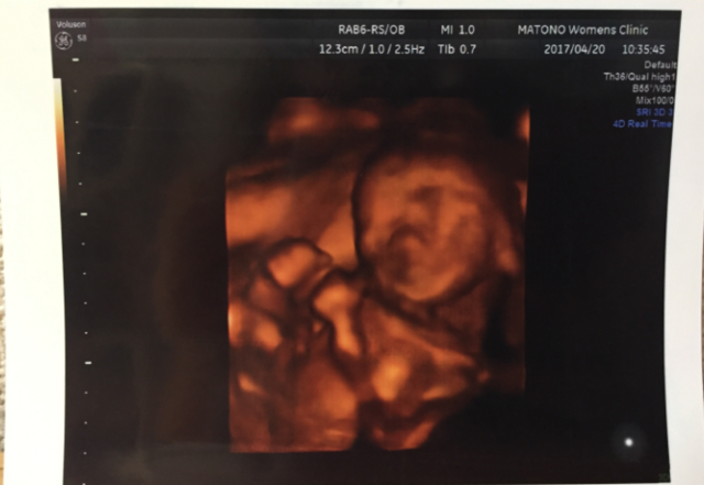 エコー写真 20週6日 20w6d 男の子,妊娠20週,エコー,