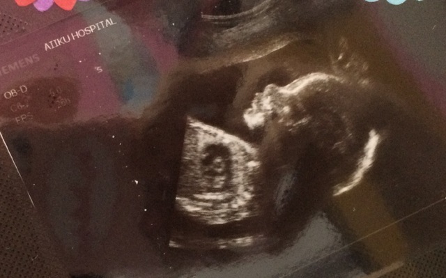 エコー写真 24週5日 24w5d 男の子,妊娠24週,エコー,