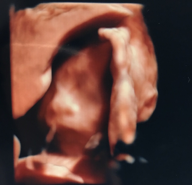 エコー写真 22週5日 22w5d 男の子,妊娠22週,エコー,
