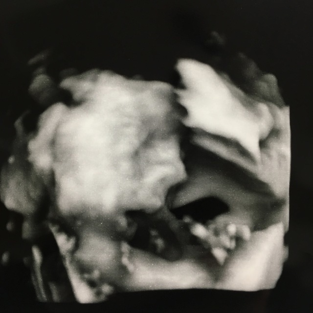 エコー写真 25週6日 25w6d 男の子,妊娠,25週,エコー写真