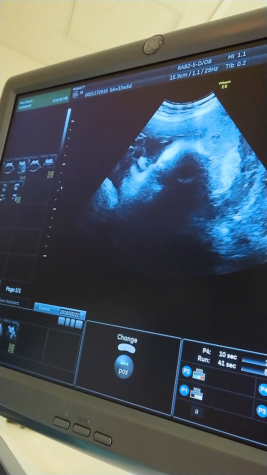 エコー写真 33週5日 33w5d 女の子,妊娠,33週,エコー写真