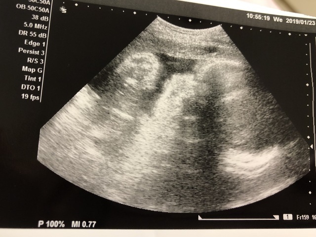 エコー写真 33週6日 33w6d 女の子,妊娠,33週,エコー写真