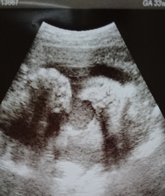 エコー写真 33週0日 33w0d 男の子,妊娠,33週,エコー写真