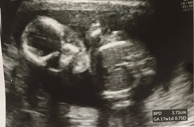 エコー写真 17週1日 17w1d 男の子,妊娠17週,エコー,
