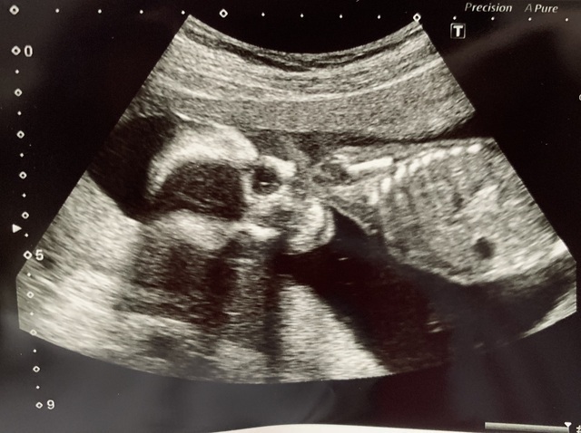 エコー写真 17週4日 17w4d 女の子,妊娠17週,エコー,