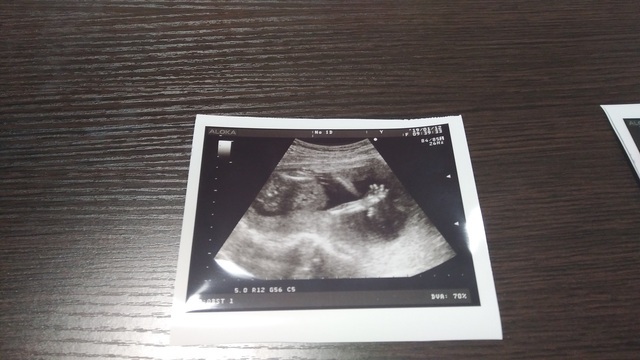 エコー写真 17週6日 17w6d 性別不明,妊娠17週,エコー,
