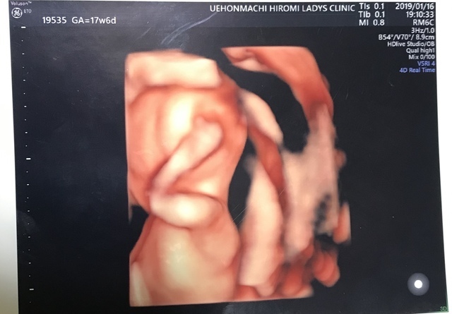 エコー写真 17週6日 17w6d 男の子,妊娠17週,エコー,