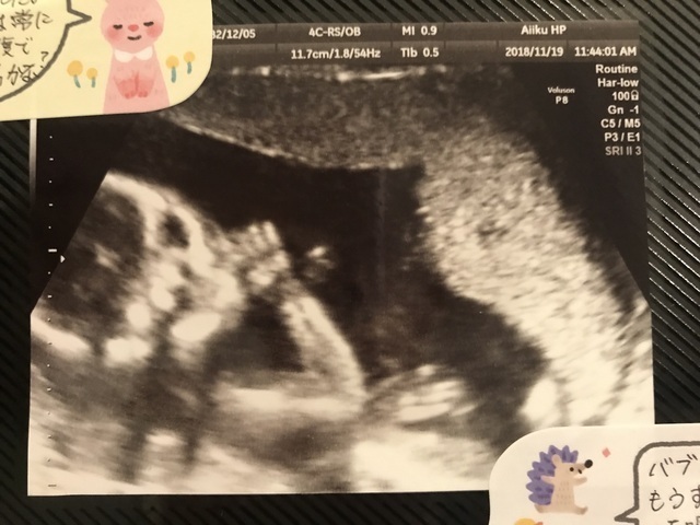 エコー写真 17週6日 17w6d 男の子,妊娠17週,エコー,
