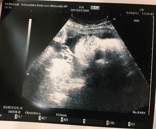 エコー写真 17週 17w 男の子,妊娠17週,エコー,