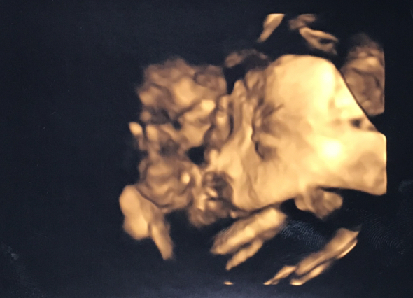 エコー写真 26週2日 26w2d 女の子,妊娠26週,エコー,
