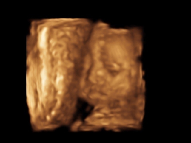 エコー写真 26週4日 26w4d 女の子,妊娠26週,エコー,