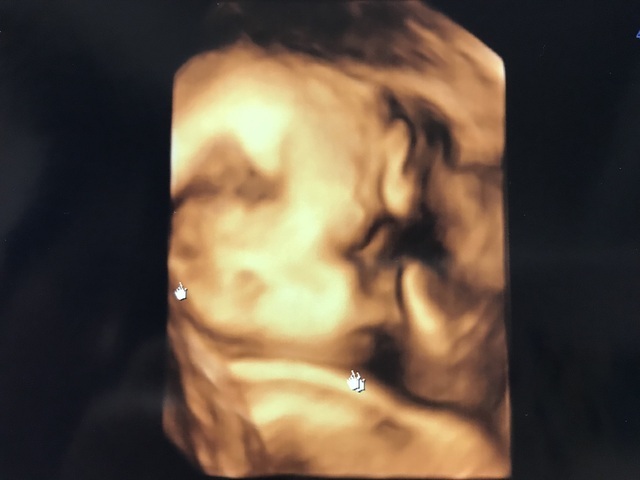 エコー写真 26週5日 26w5d 男の子,妊娠26週,エコー,