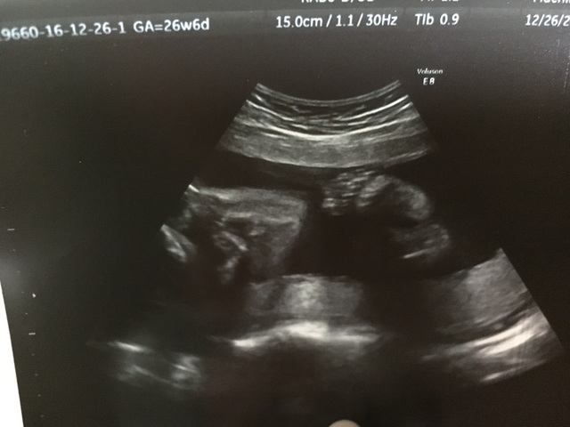 エコー写真 26週6日 26w6d 女の子,妊娠26週,エコー,