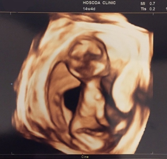 エコー写真 14週4日 14w4d 男の子,妊娠14週,エコー写真,