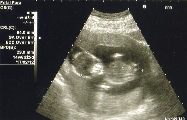 エコー写真 14週6日 14w6d 男の子,妊娠14週,エコー写真,
