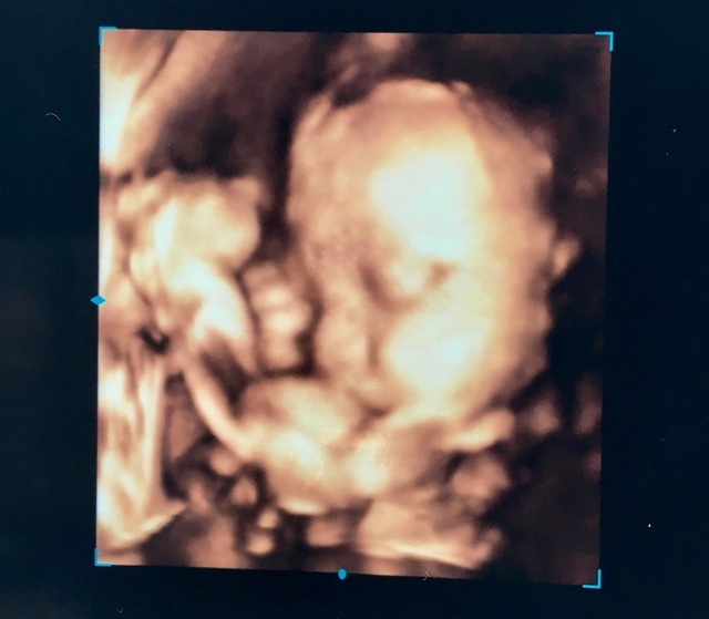 エコー写真 28週1日 28w1d 女の子,妊娠28週,エコー,