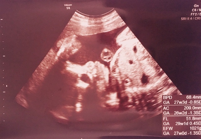 エコー写真 28週3日 28w3d 女の子,妊娠28週,エコー,