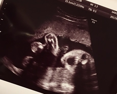 エコー写真 28週4日 28w4d 女の子,妊娠28週,エコー,